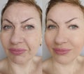 Woman face wrinkles saggy removal mature care before and after aging hydrating treatment