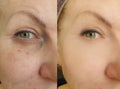 Woman face wrinkles  puffiness  correction   before and after lifting treatment collage Royalty Free Stock Photo