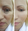 Woman face wrinkles regeneration differencecosmetology before and after treatment