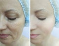 Woman face wrinkles regeneration mature differencecosmetology before and after treatment