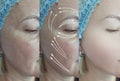 Woman face wrinkles aging revitalization difference therapy before and after regeneration removal hydrating treatment Royalty Free Stock Photo