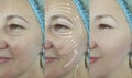 Woman face wrinkles before and after regeneration removal hydrating treatment Royalty Free Stock Photo