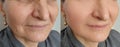 woman face wrinkles before and after treatment sagging crease