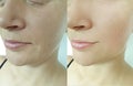 Woman face wrinkles antiaging saggy rejuvenation medicine lifting before and after treatment