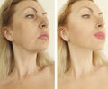 Woman face wrinkles before and after thread lifting treatment facelift