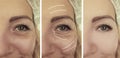Woman face wrinkles before and after results  collage treatments effect Royalty Free Stock Photo