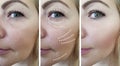 Woman face wrinkles before and after collage treatments effect Royalty Free Stock Photo