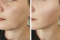 Woman face wrinkles lifting correction before after antiaging revitalization treatments