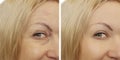 Woman face wrinkles before and after