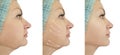 Woman facial chin lift before and after clinic procedures liposuction