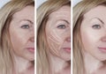 Woman facial wrinkles correction beautician results lifting difference before and after procedures arrow