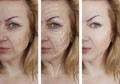 Woman facial wrinkles skin correction effect cosmetology aging before and after procedures arrow