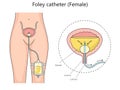 Woman foley catheter diagram medical science
