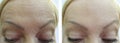 Woman forehead wrinkles before and after correction ageing treatment Royalty Free Stock Photo