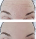 Woman forehead wrinkles before and after correction