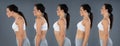 Woman With Lordosis, Kyphosis, Sway Back And Normal Curvature Royalty Free Stock Photo