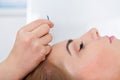 Woman getting acupuncture treatment