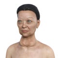 A woman with Graves' disease, 3D illustration