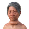 A woman with Graves' disease, 3D illustration