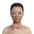 A woman with Graves' disease, 3D illustration