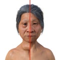 A woman with Graves' disease and the same healthy person, 3D illustration