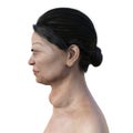 A woman with Graves' disease, 3D illustration.