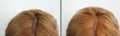 Woman hair baldness before and after treatment Royalty Free Stock Photo