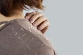 Closeup woman hair with dandruff scalp falling on shoulders Royalty Free Stock Photo