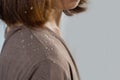 Closeup woman hair with dandruff scalp falling on shoulders Royalty Free Stock Photo