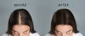 Woman with hair loss problem before and after treatment on grey background, collage. Visiting trichologist