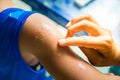 Woman hand to treat the patient`s arm with Ointment mosquito bites