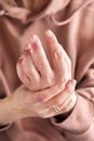 Woman hands with atopic dermatitis, eczema, allergy reaction on skin Royalty Free Stock Photo