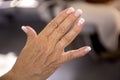 Woman hands with rheumatism arthritis and skin blemishes