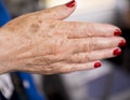 Woman hands with rheumatism arthritis and skin blemishes