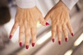 Woman hands with rheumatism arthritis and skin blemishes