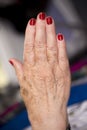 Woman hands with rheumatism arthritis and skin blemishes