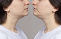 The woman has a double chin. Chin reshaping, fat removal, lifting. Collage comparison before and after treatment Royalty Free Stock Photo