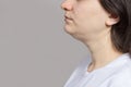 The woman has a double chin. Treatment, chin reshaping, fat removal, lifting. Place for text copy space. Royalty Free Stock Photo