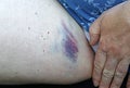 A woman has a large painful bruise bruise on her inner thigh