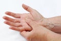 A woman has pain in her hands and fingers suffers from dry skin Royalty Free Stock Photo