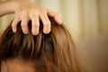 A woman has problems with hair and scalp,she has dandruff from allergic reactions to shampoos.