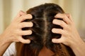 A woman has problems with hair and scalp,she has dandruff from allergic reactions to shampoos.