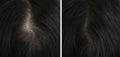 Woman head hair problem show baldness before and after treatment