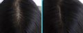 Woman head hair baldness before and after treatment