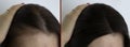 Woman head hair baldness before and after problem  treatment Royalty Free Stock Photo