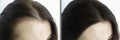 Woman head hair baldness before and after treatment Royalty Free Stock Photo