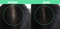 Woman head hair problem baldness before and after treatment