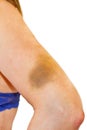 Woman with a hematoma