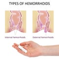 Woman holding suppository for hemorrhoid treatment under illustrations of lower rectum on background