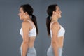 Woman With Kyphosis And Normal Curvature